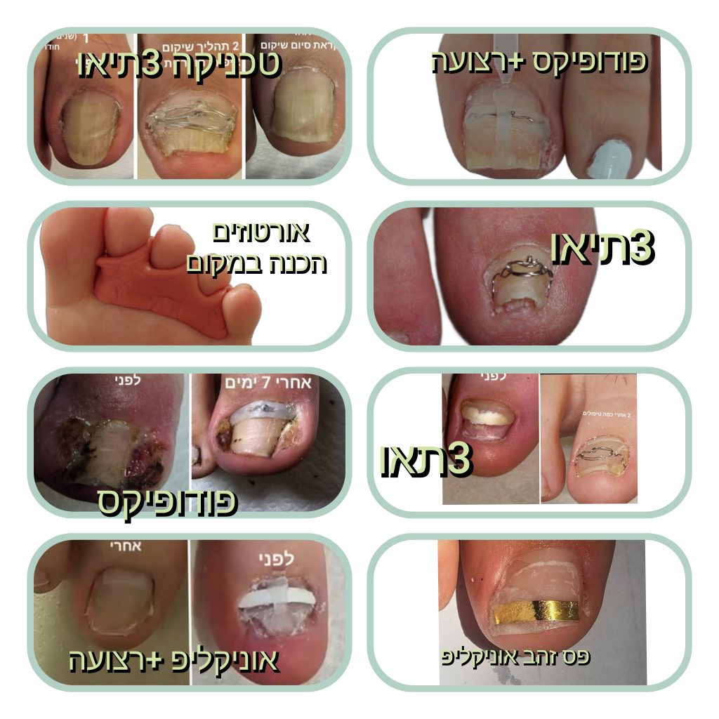 טיפול בציפורניים חודרניות בטכניוקת הכי מתקדמות בעולם ash pro
