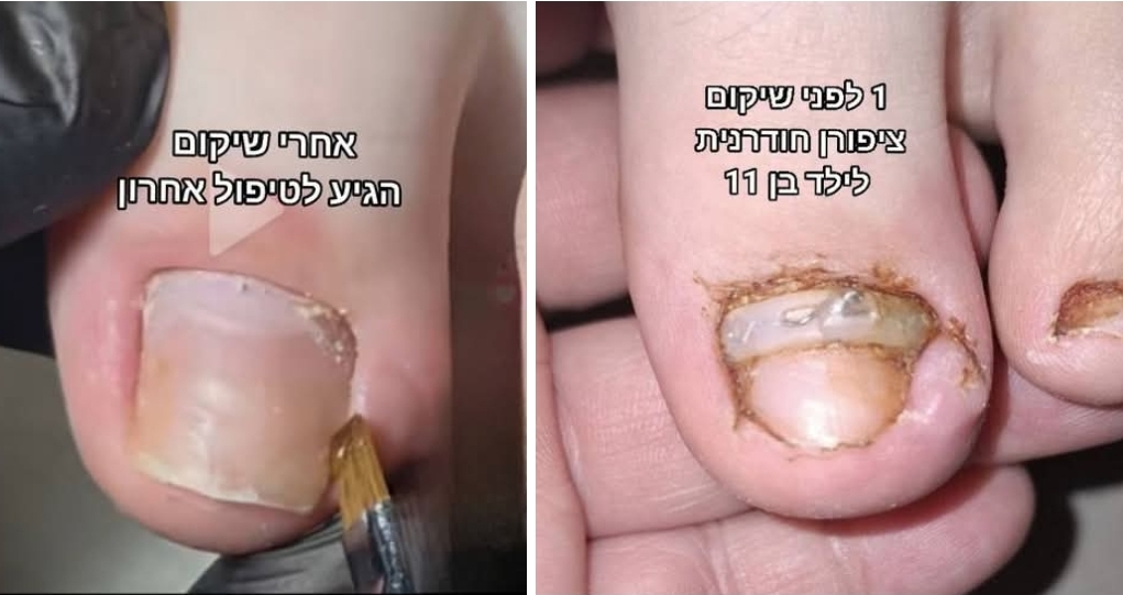טיפול ציפורן חודרנית