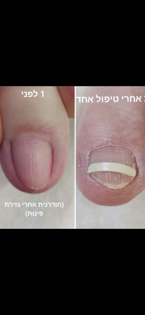 טיפול ציפורן חודרנית