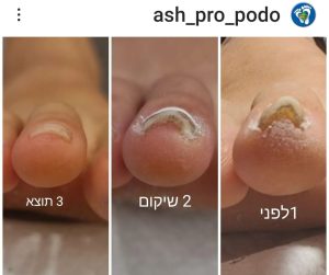 ציפורן חודרנית שיקום ללא כאב וללא ניתוח