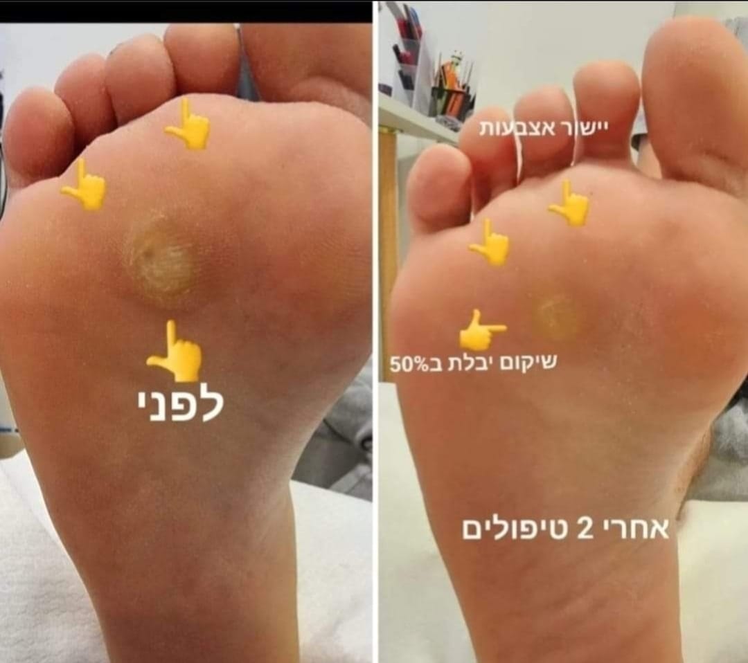 יבלות - Boost For Life