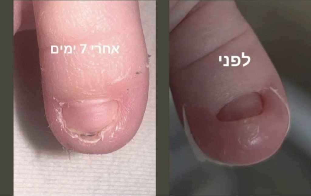ציפורן חודרנית